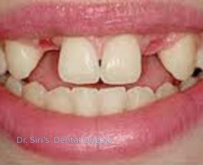 Dental Implant Procedure