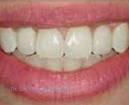 Dental Implants Result