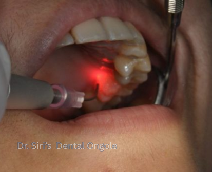 Painless Dental Treatment