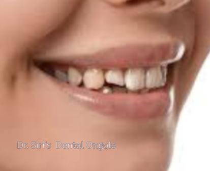 Smile Design Veneers Before After